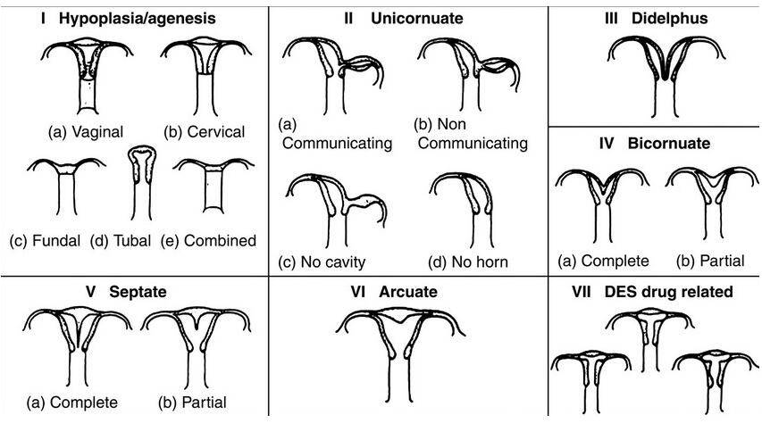 子宫畸形会引起不孕 这是真的吗