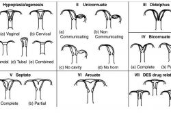 子宫畸形会引起不孕 这是真的吗