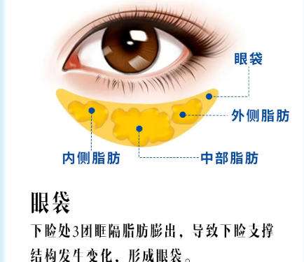 去眼袋 去眼袋