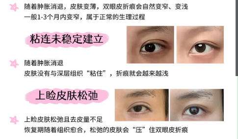双眼皮 .jpg 双眼皮 .jpg