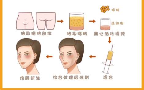 自体脂肪填充面部