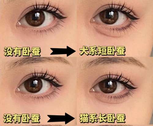 真皮卧蚕再造dm.jpg