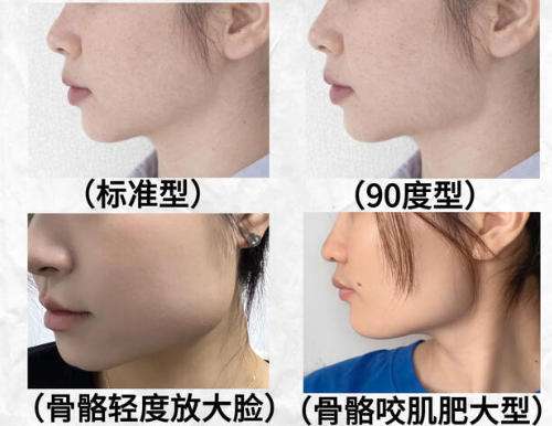 下颌角3.jpg
