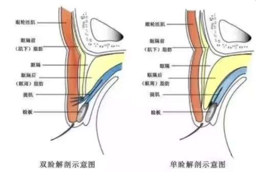 双眼皮 双眼皮