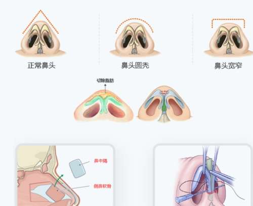 鼻综合