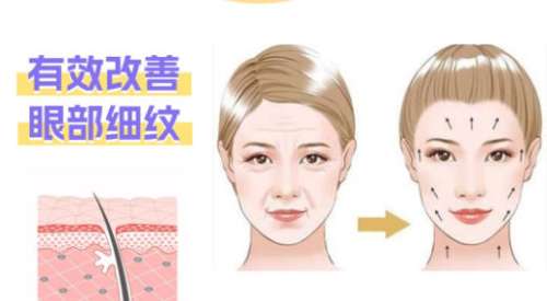 除皱 除皱