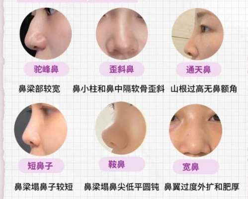 隆鼻