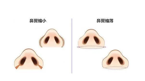 缩鼻头会影响呼吸吗?效果好吗?避免后遗症的注意事项收藏起来!