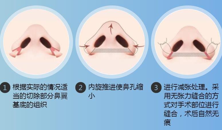缩小鼻孔多少钱？手术方式不同价格也不同！