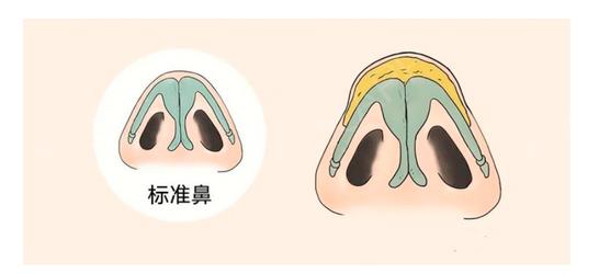 缩小鼻孔多少钱？手术方式不同价格也不同！