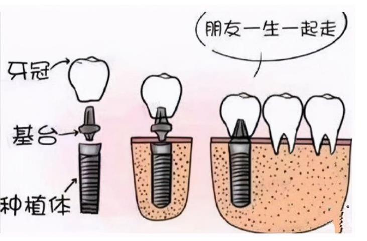 上海科瓦口腔种植牙多少钱？价格表23年_近期案例反馈图