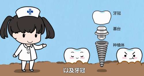 牙齿种植 牙齿种植