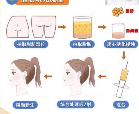 脂肪填充1.jpg 脂肪填充1.jpg