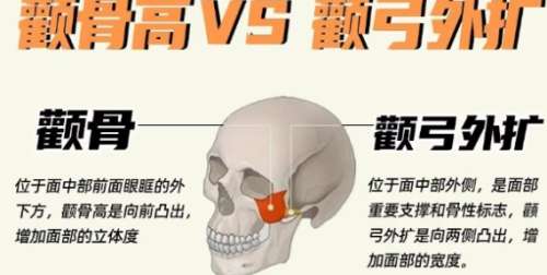 颧骨整形