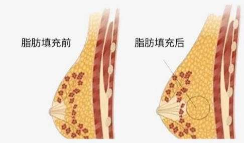 隆胸 隆胸