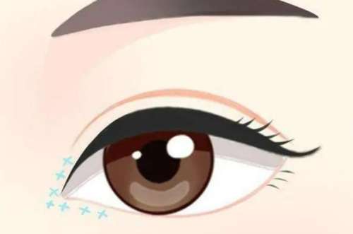 双眼皮 双眼皮