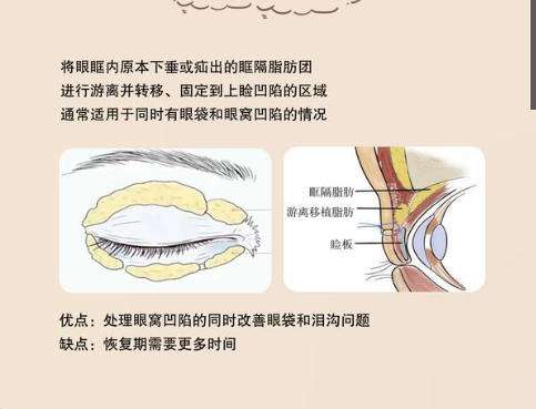 脂肪填充2.jpg 脂肪填充2.jpg