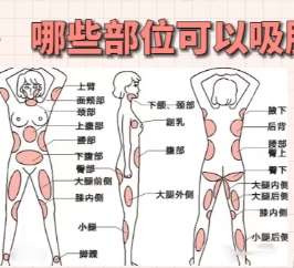 吸脂