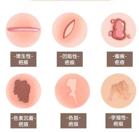 隆鼻 隆鼻