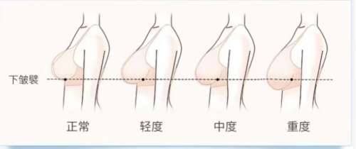 隆胸 隆胸