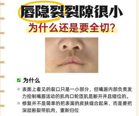 唇裂修复.jpg 唇裂修复.jpg