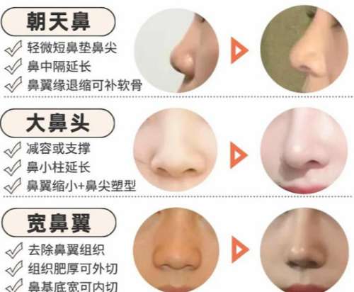 鼻综合 鼻综合