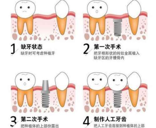 牙齿种植