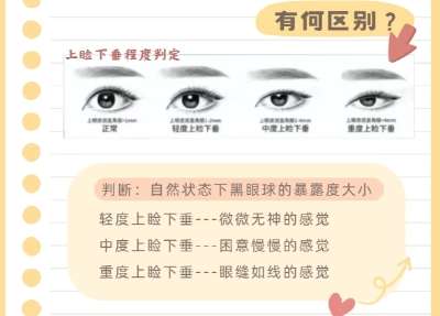 双眼皮