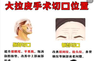 拉皮