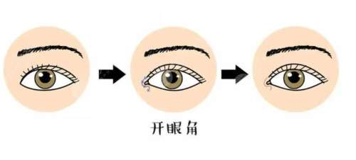 开眼角