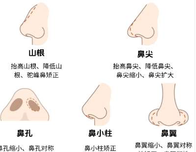 隆鼻
