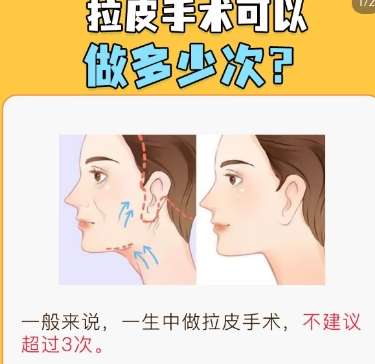 拉皮 拉皮