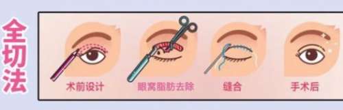 双眼皮原理图02.jpg