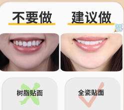 全瓷贴面