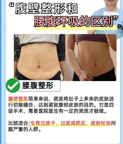 吸脂 吸脂