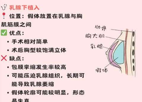 丰胸3.jpg