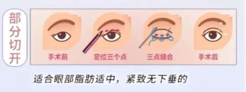 双眼皮