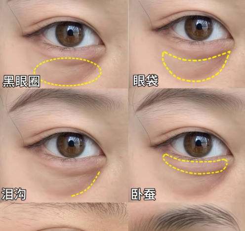 眼袋8.jpg