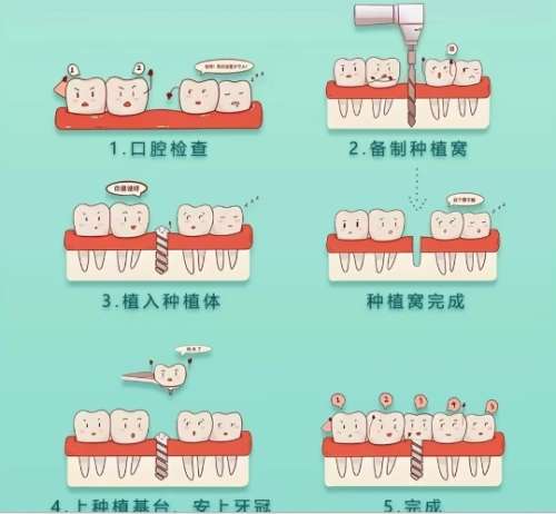 牙齿种植