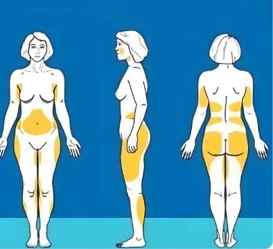 吸脂 吸脂