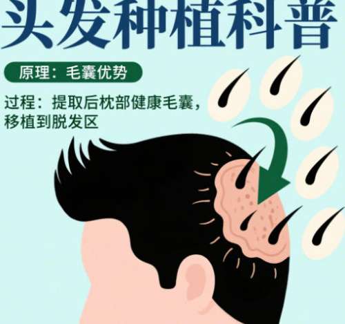 植发 植发