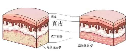 吸脂