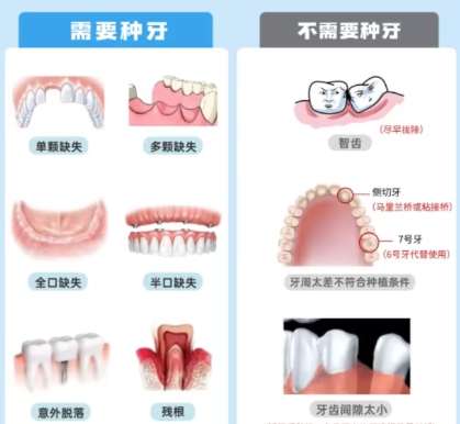 牙齿种植