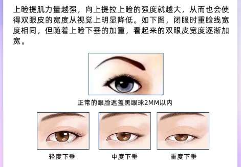 双眼皮 双眼皮