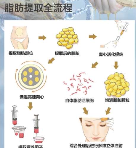 脂肪填充
