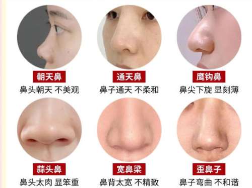 鼻综合 鼻综合