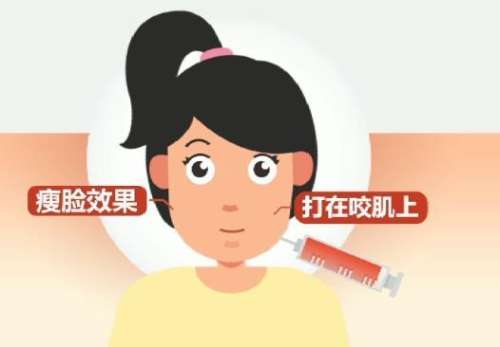 注射瘦脸 注射瘦脸