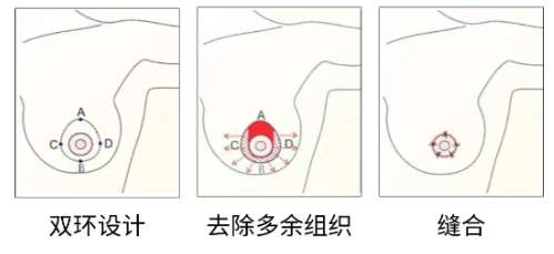 隆胸