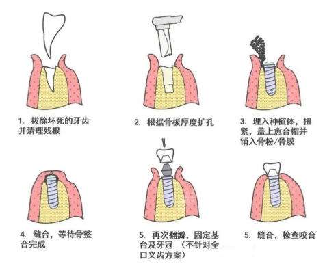 牙齿种植 牙齿种植