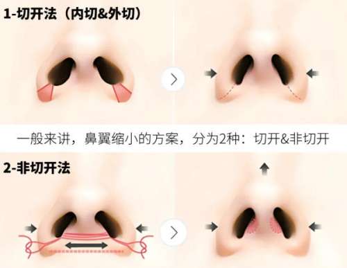 鼻翼缩小 鼻翼缩小